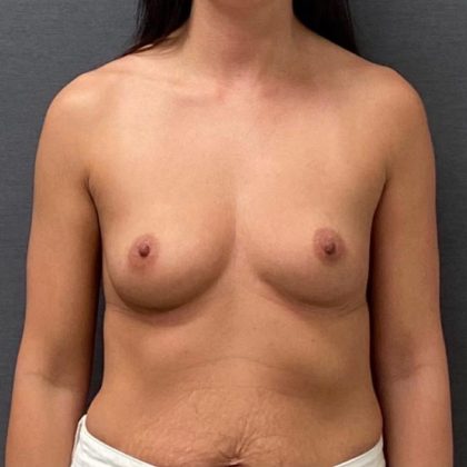 Breast Augmentation Before & After Patient #15990