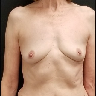 Breast Augmentation Before & After Patient #15973