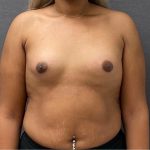 Breast Augmentation Before & After Patient #15991