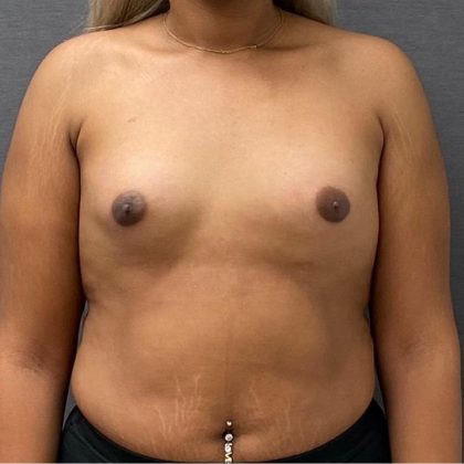 Breast Augmentation Before & After Patient #15991