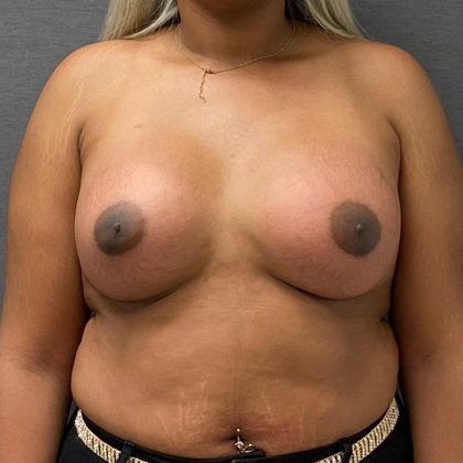 Breast Augmentation Before & After Patient #15991
