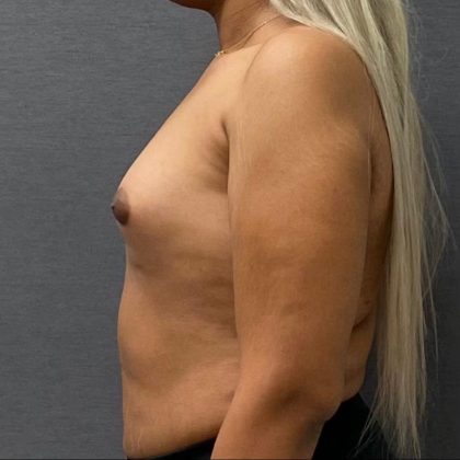Breast Augmentation Before & After Patient #15991