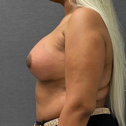 Breast Augmentation Before & After Patient #15991