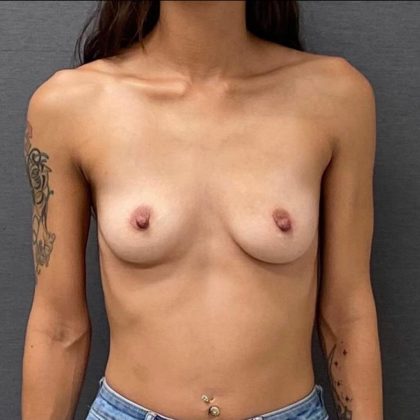Breast Augmentation Before & After Patient #15992