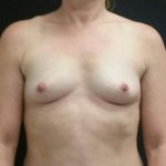 Breast Augmentation Before & After Patient #15974
