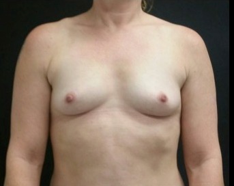 Breast Augmentation Before & After Patient #15974