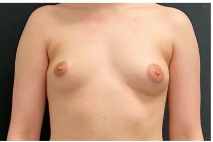 Breast Augmentation Before & After Patient #15975