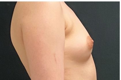 Breast Augmentation Before & After Patient #15975