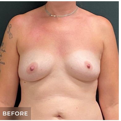Breast Augmentation Before & After Patient #15976