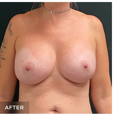 Breast Augmentation Before & After Patient #15976