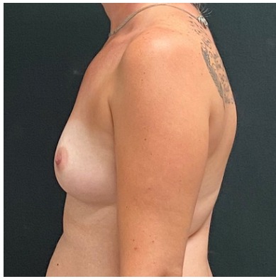 Breast Augmentation Before & After Patient #15976