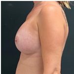 Breast Augmentation Before & After Patient #15976