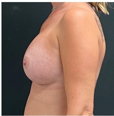 Breast Augmentation Before & After Patient #15976