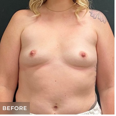 Breast Augmentation Before & After Patient #15977