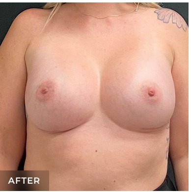 Breast Augmentation Before & After Patient #15977