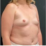 Breast Augmentation Before & After Patient #15977
