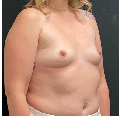 Breast Augmentation Before & After Patient #15977
