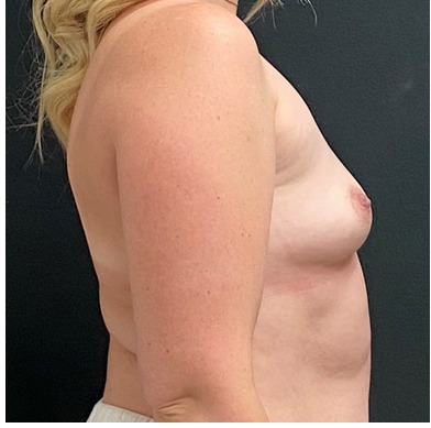 Breast Augmentation Before & After Patient #15977