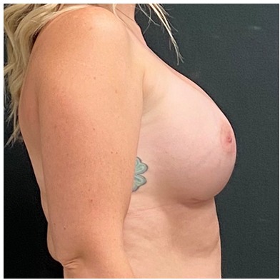 Breast Augmentation Before & After Patient #15977