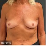 Breast Augmentation Before & After Patient #15978