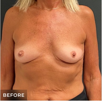 Breast Augmentation Before & After Patient #15978