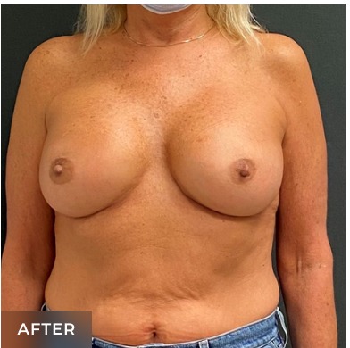 Breast Augmentation Before & After Patient #15978