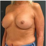 Breast Augmentation Before & After Patient #15978