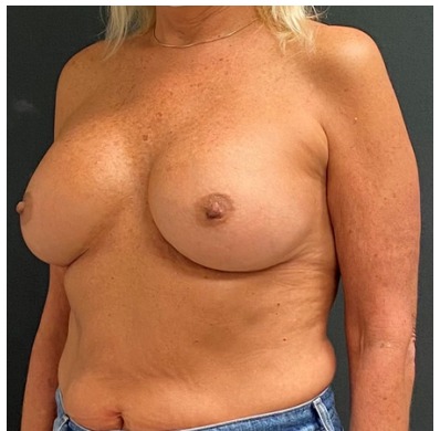 Breast Augmentation Before & After Patient #15978