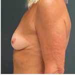 Breast Augmentation Before & After Patient #15978