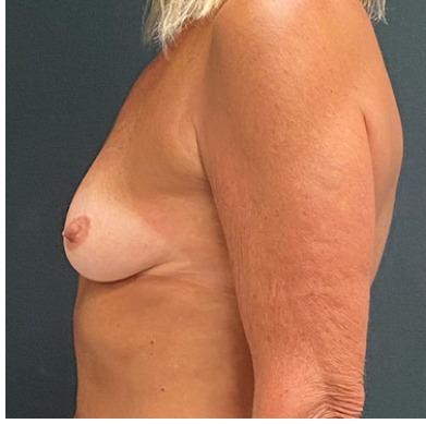 Breast Augmentation Before & After Patient #15978