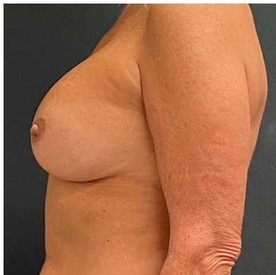 Breast Augmentation Before & After Patient #15978