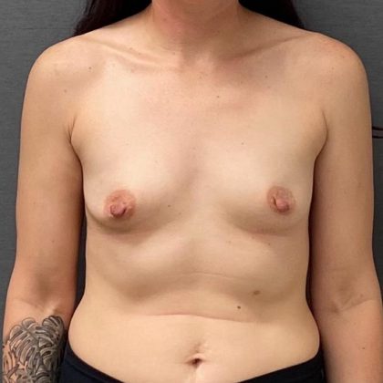 Breast Augmentation Before & After Patient #15980