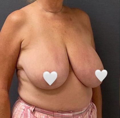 Breast Reduction Before & After Patient #16002
