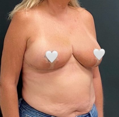 Breast Reduction Before & After Patient #16002