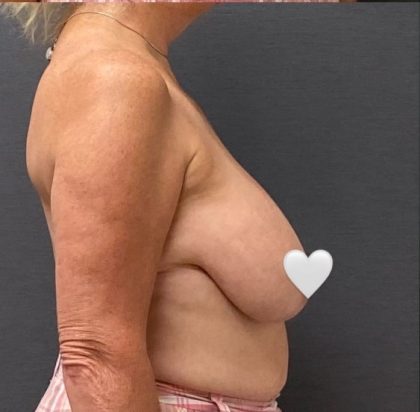 Breast Reduction Before & After Patient #16002