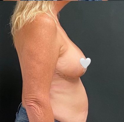 Breast Reduction Before & After Patient #16002