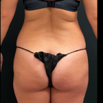 Liposuction Female Before & After Patient #15968