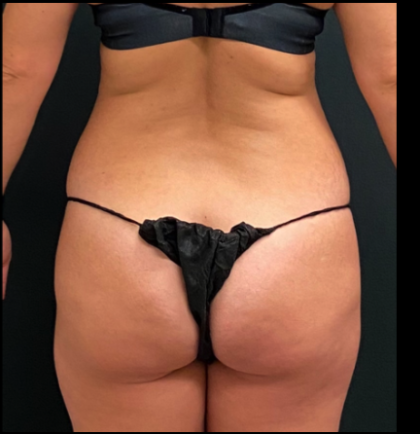 Liposuction Female Before & After Patient #15968