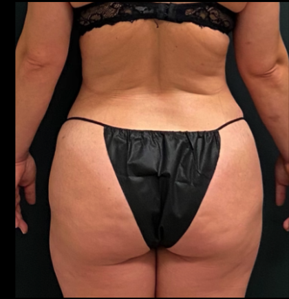 Liposuction Female Before & After Patient #15968