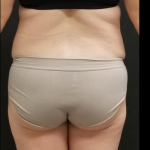 Liposuction Female Before & After Patient #15969