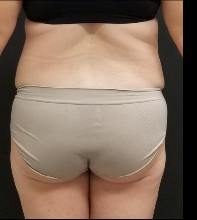 Liposuction Female Before & After Patient #15969