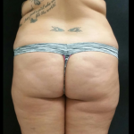 Liposuction Female Before & After Patient #15970