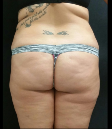 Liposuction Female Before & After Patient #15970