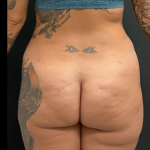 Liposuction Female Before & After Patient #15970