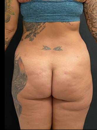 Liposuction Female Before & After Patient #15970