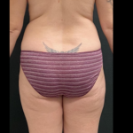 Liposuction Female Before & After Patient #15971