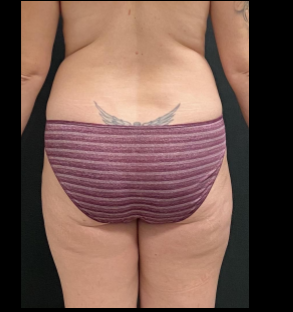 Liposuction Female Before & After Patient #15971