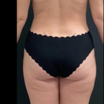 Liposuction Female Before & After Patient #15971