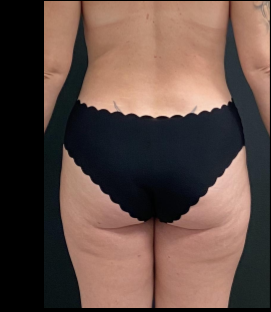 Liposuction Female Before & After Patient #15971