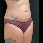 Liposuction Female Before & After Patient #15971